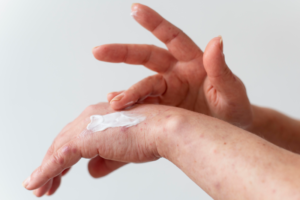 Close-up of irritated skin being examined by urgent care provider for possible infection in Torrance during summer